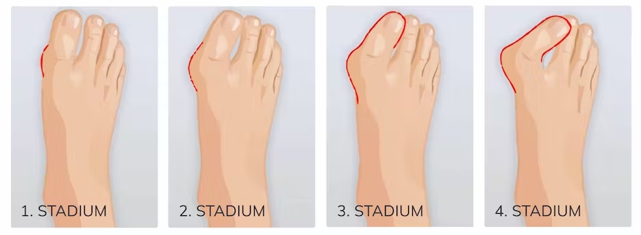 7e5fa187-ecbc-4936-b458-d2e86a4476c5_beratung-teaser-hallux-stadien-2496x918.jpg 7e5fa187-ecbc-4936-b458-d2e86a4476c5_beratung-teaser-hallux-stadien-2496x918.jpg