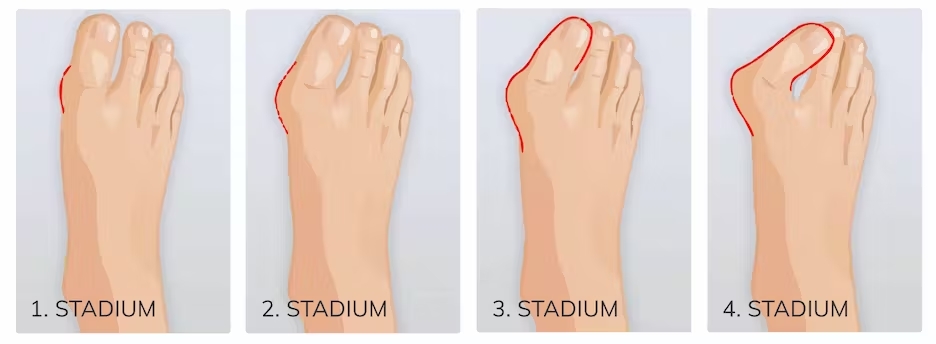 7e5fa187-ecbc-4936-b458-d2e86a4476c5_beratung-teaser-hallux-stadien-2496x918.jpg